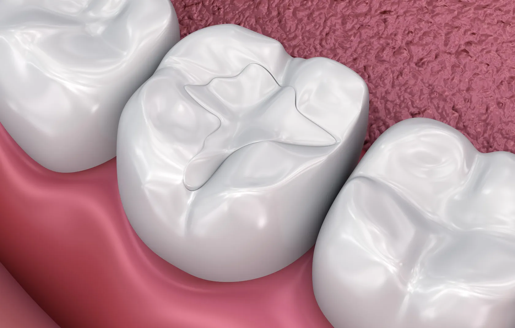 Understanding Dental Fillings