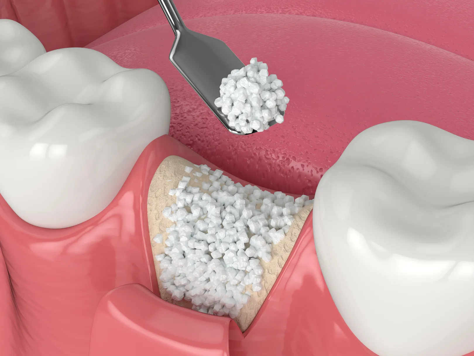 Understanding Bone Grafting