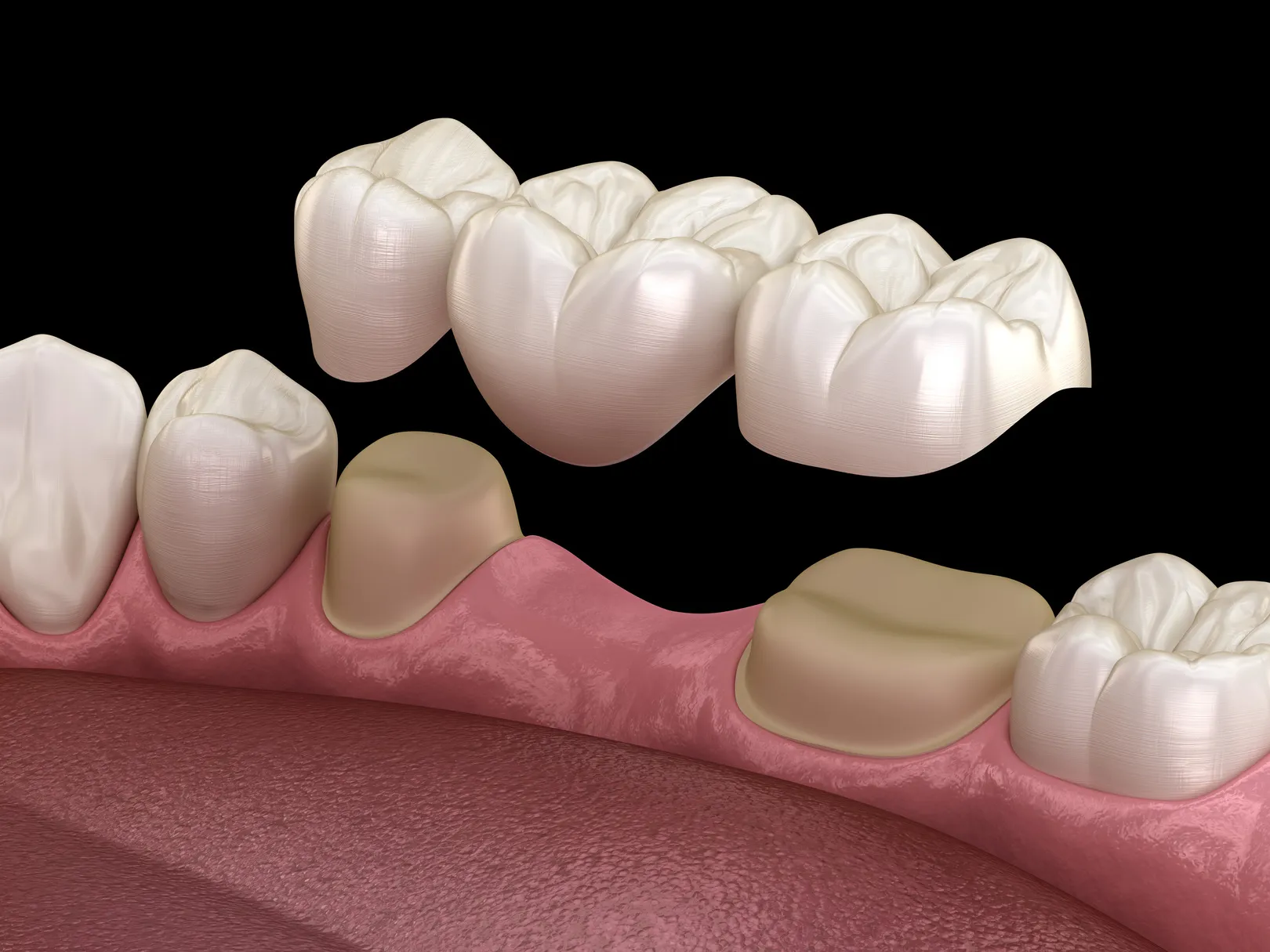 What Are Dental Bridges?