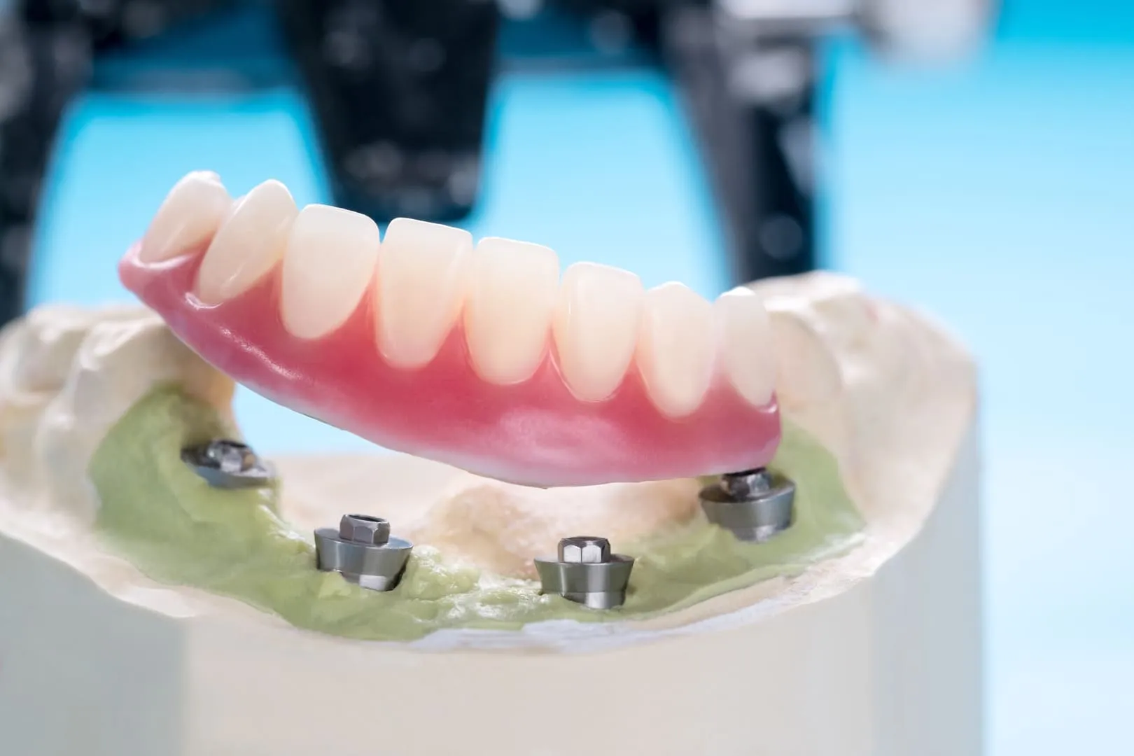 Implant Supported Dentures: The Fusion of Stability and Comfort in Fort Collins