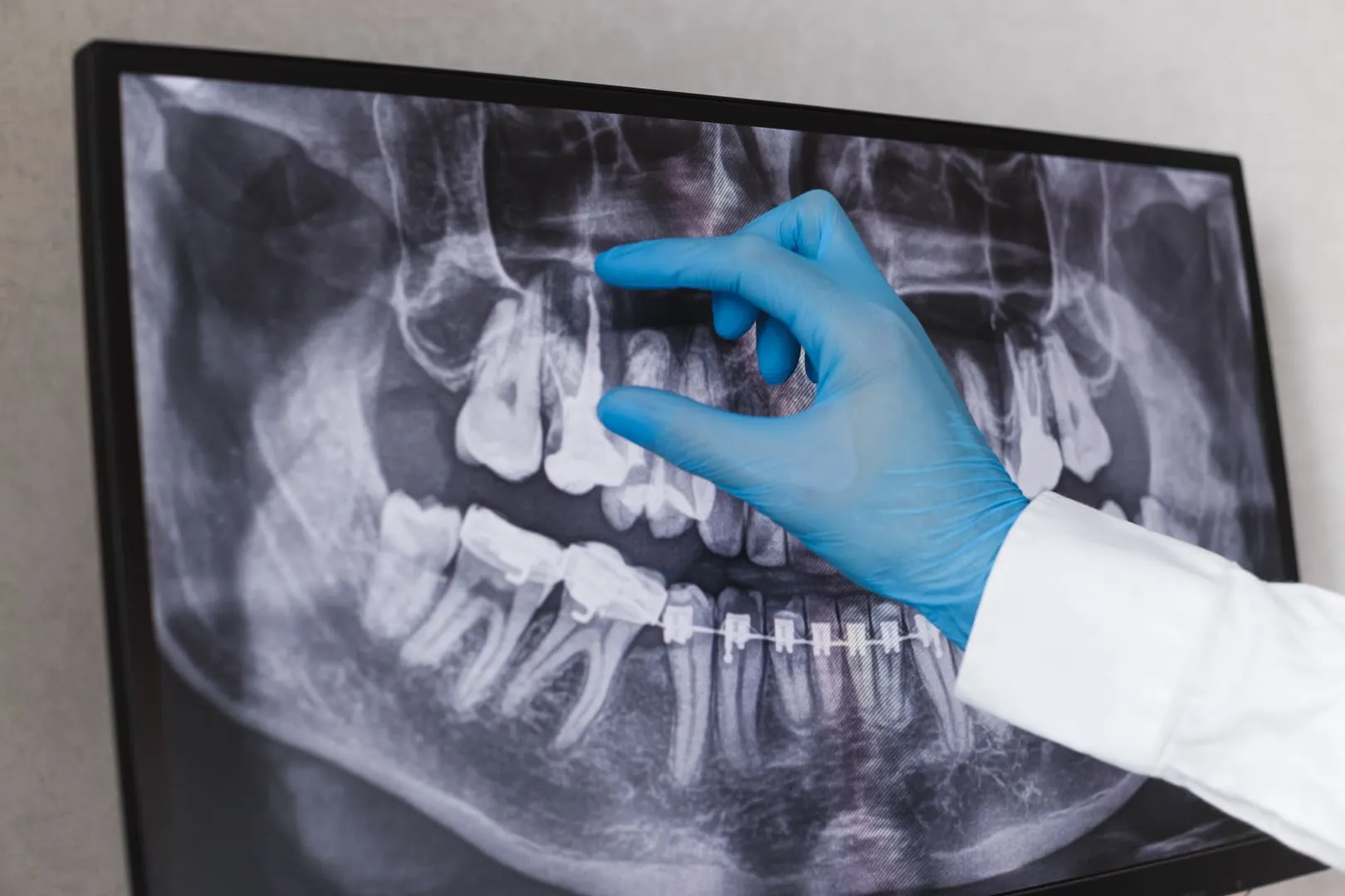Expert Root Canal Treatment in Fort Collins, CO