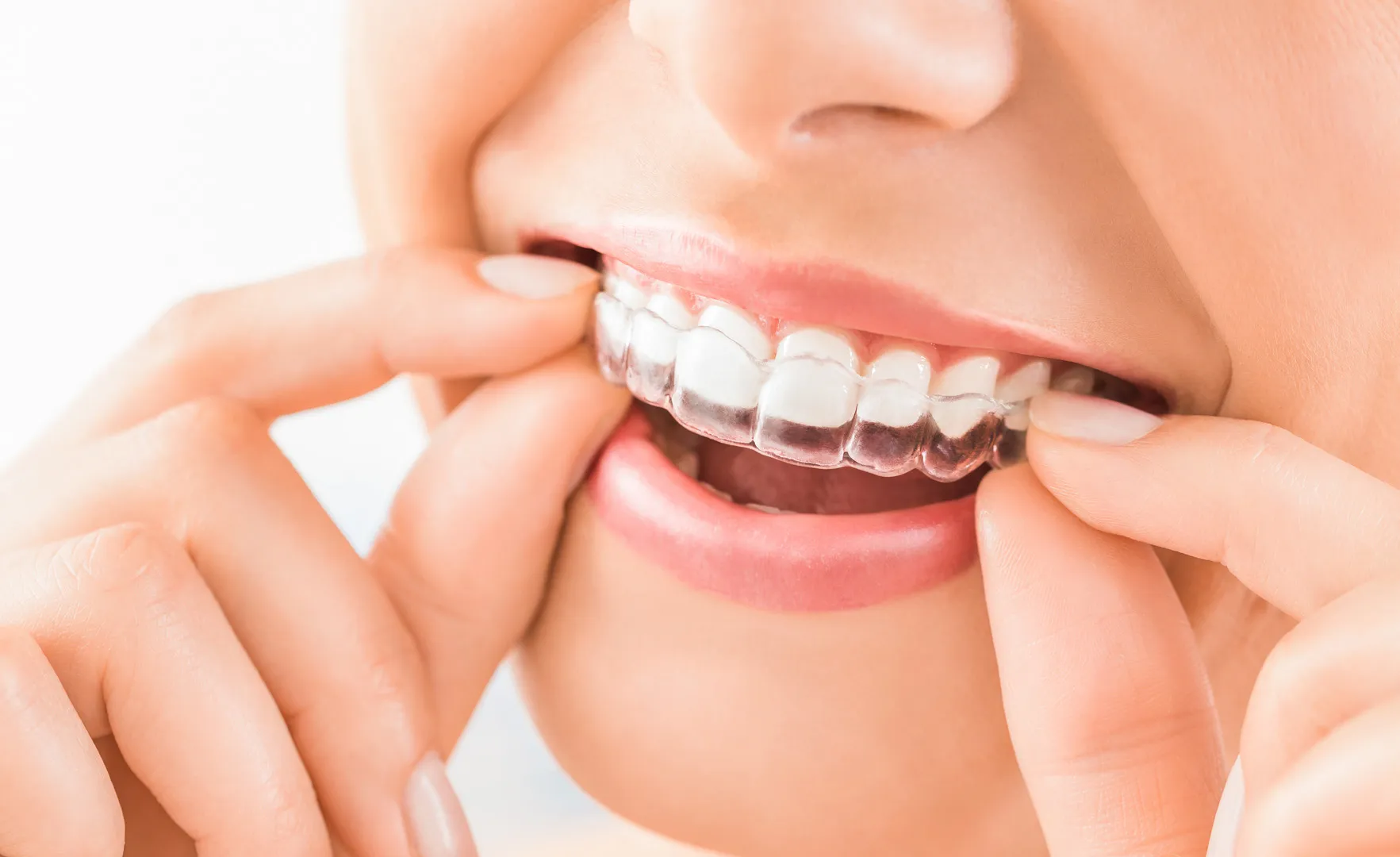 Achieve Your Best Smile with Invisalign in Fort Collins