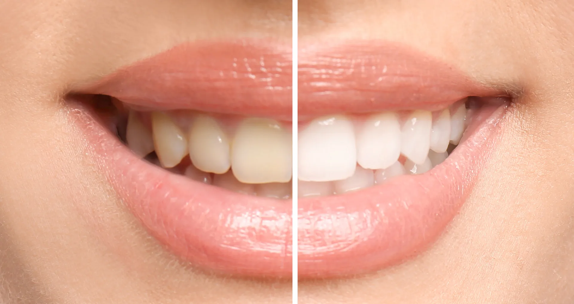 Professional Teeth Whitening in Fort Collins